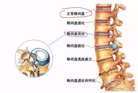 最新腰椎盘研究动态与进展探讨